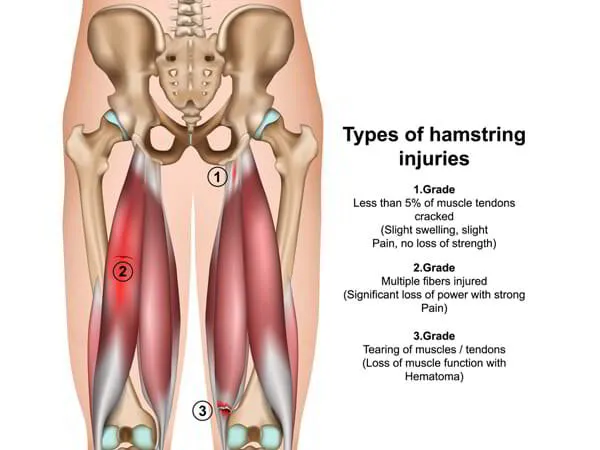 Hamstring Repair Dr. Pradyumna