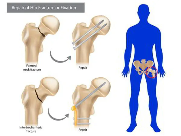 Hip Fracture Surgery Dr. Pradyumna