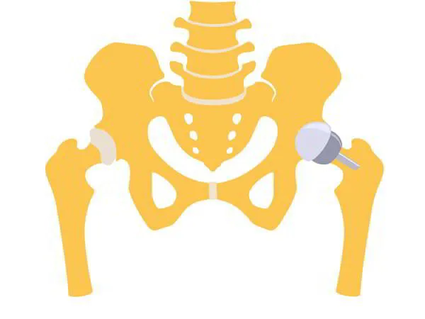 Hip Resurfacing Dr. Pradyumna