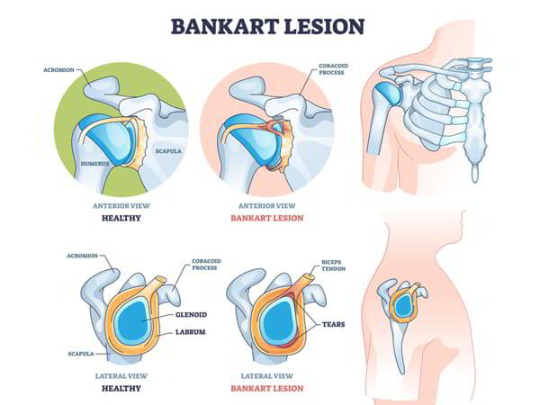 Shoulder Arthroscopic Bankart Repair Dr. Pradyumna