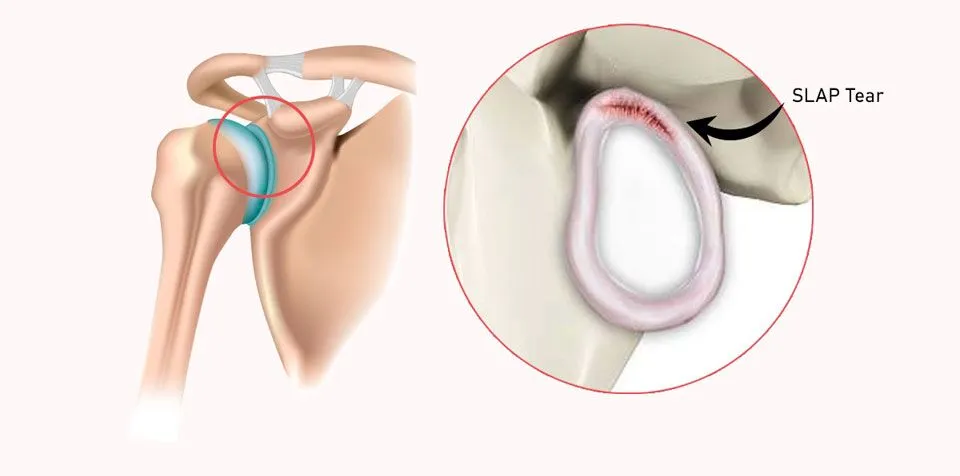 SLAP Repair Surgeon Dr. Pradyumna